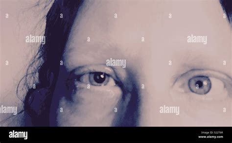 Geschwollenes Auge Fotos Und Bildmaterial In Hoher Auflösung Alamy