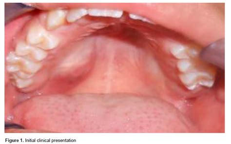 Journal Of Dentistry And Oral Hygiene Paediatric Mucoepidermoid