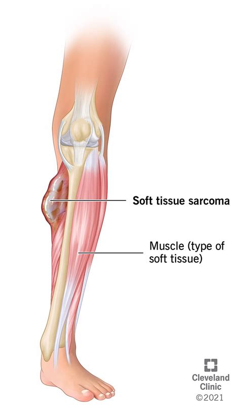 Soft Tissue Sarcoma Symptoms Treatment Prognosis