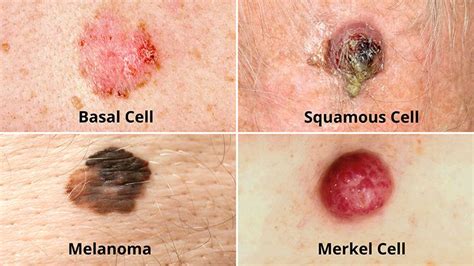 What Are The Different Types Of Skin Cancer Christ Memorial