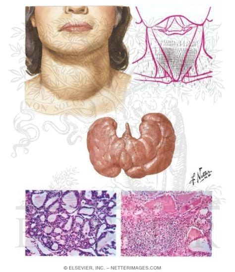 Thyroid Pathology In Diffuse Hyperthyroidism Graves Disease
