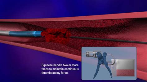 Tz Medical Control Mechanical Thrombectomy System