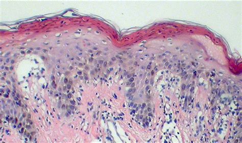 Necrolytic Acral Erythema