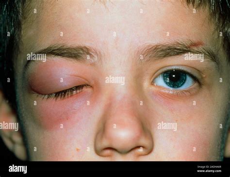 Cellulitis View Of The Face Of An Eight Year Old Boy Showing One Eye