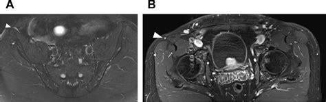 Mr Imaging Of Entrapment Neuropathies Of The Lower Extremity