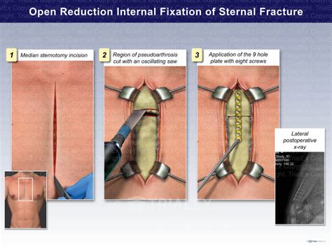 Open Reduction Internal Fixation Of Sternal Fracture Trial Exhi