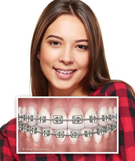 Orthodontist Valdosta Invisalign Thomasville Types Of Braces
