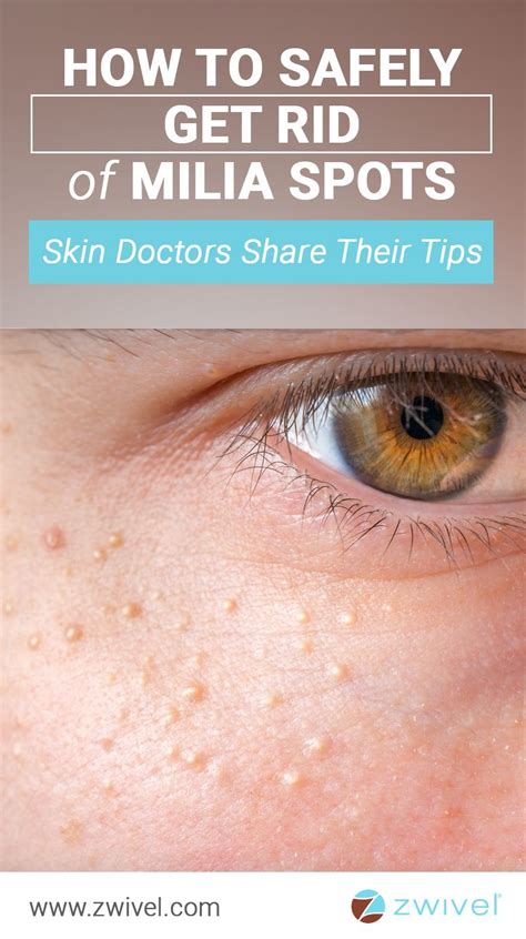 10 White Bumps On Skin Image Ideas