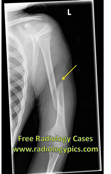A fractured humerus is common and may result from injury. Left humerus fracture: radiograph of the left humerus shows an obliquely oriented fracture ...