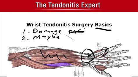 Wrist Tendonitis Surgery Basics Better To Know Now Than Later Youtube