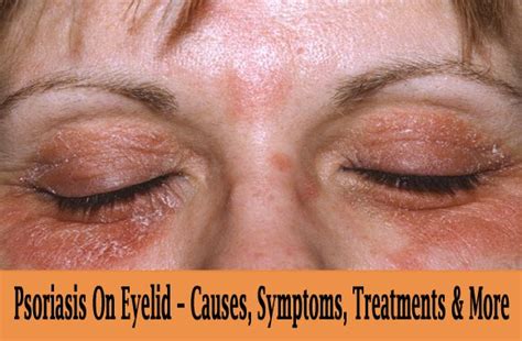 Psoriasis On Eyelid Causes Symptoms Treatments And More Psoriasis