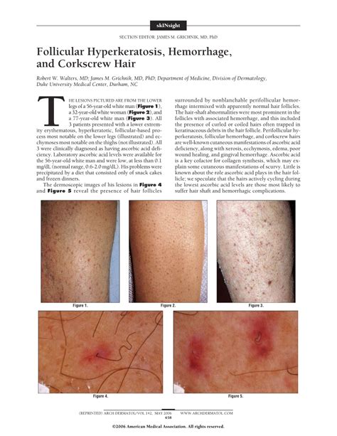 Follicular Hyperkeratosis Hemorrhage And Corkscrew Hair Dermatology