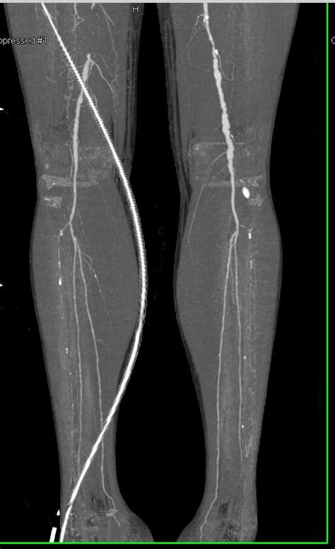 Superficial Femoral Artery Sfa Occlusion With Severe Peripheral