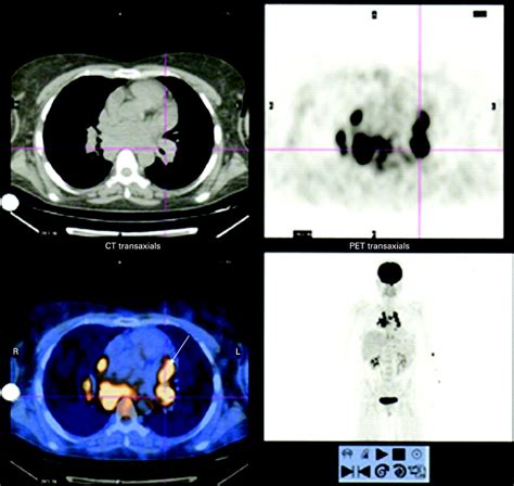 Whole Body 18 Fdg Petct Imaging For Lymph Node And Metastatic Staging