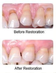 Manhattan Dentist Periodontics Periodontal Gum Restoration