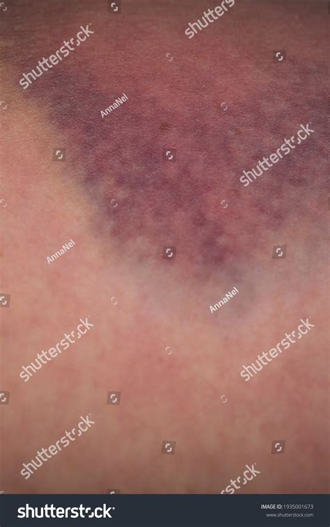 Closeup On Bruise On Wounded Woman Stock Photo 1935001673 Shutterstock