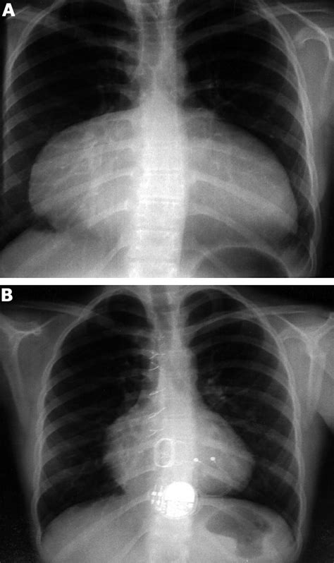 Severe Tricuspid Regurgitation 14 Years After Diagnosis Of “transient