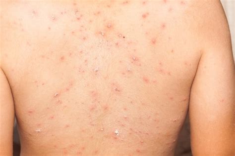 Pityriasis Lichenoides What It Is Causes Symptoms And Treatment