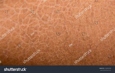Dry Skin Ichthyosis Detail Stock Photo 160854098 Shutterstock