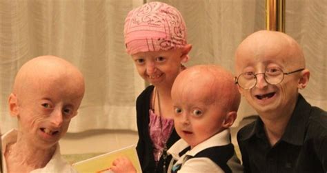 Progeria Memes