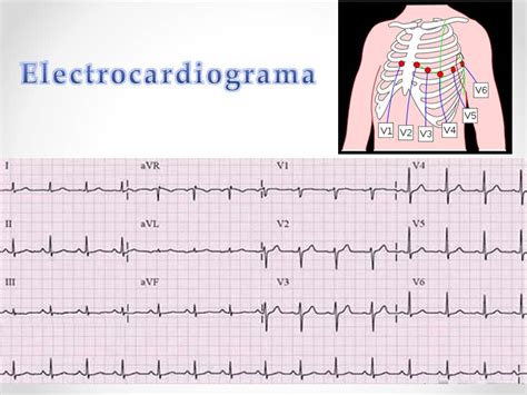 Imagen Electrocardiograma