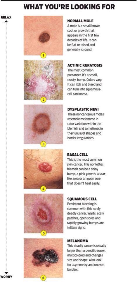 Understanding The Different Types Of Skin Cancer Vrogue Co