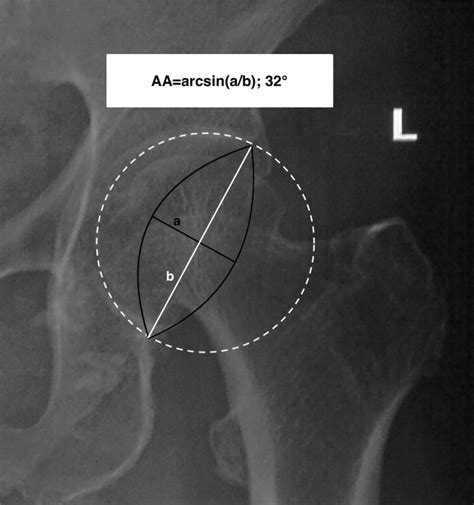 An Anteroposterior Radiograph Showing The Calculation Of Acetabular