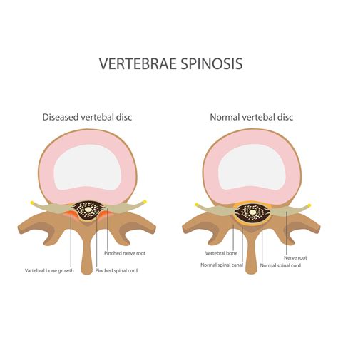 Foraminal Stenosis Treatment Minimally Invasive Spine Surgery