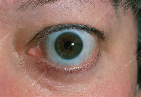 Bulging Eye Exophthalmos Due To Thyrotoxicosis Stock Image M270