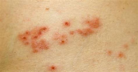 how is shingles diagnosed livestrong
