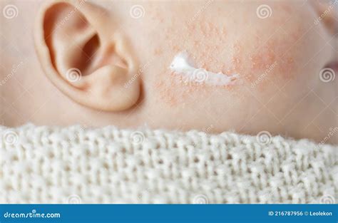 Ointment Or Cream Applied On Baby Dermatitis Cheek Stock Photo Image