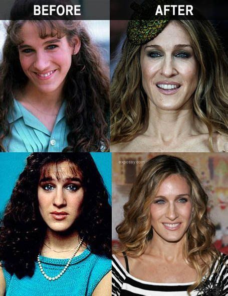 Sarah Jessica Parker Plastic Surgery Before And After