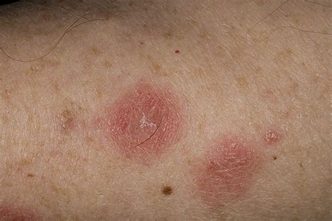 What Is Nummular Eczema