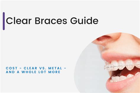 Clear Ceramic Braces 2023 Clear Braces Vs Metal Braces