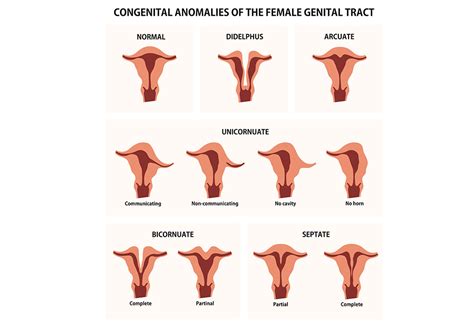 Abnormalities Of The Uterus In Pregnancy Types Risks Treatment