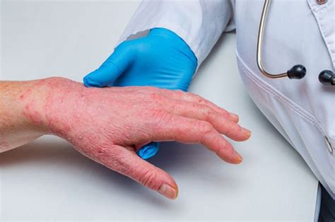 Coronavirus Symptoms A Skin Rash Should Be Classed As A Fourth Key