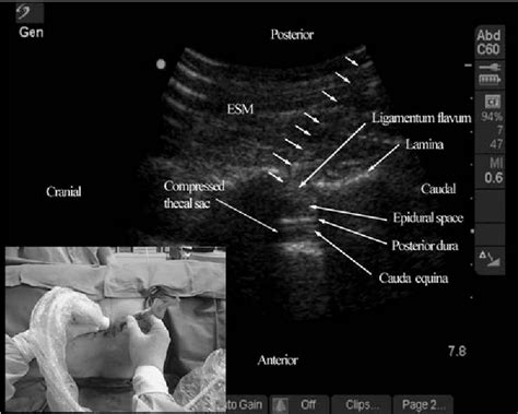 Figure 4 From Real Time Ultrasound Guided Paramedian Epidural Access