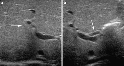 Check spelling or type a new query. Persistent neonatal cholestasis and biopsy-proven bilia ...