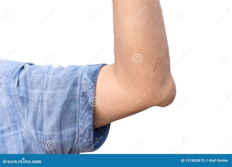Swollen Elbow By Inflamed Joint In Front Of White Background Stock
