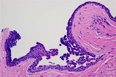 Giant Multi Loculated Apocrine Hidrocystomas