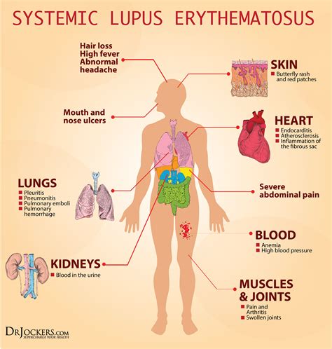 Ways To Heal Systemic Lupus Naturally Drjockers