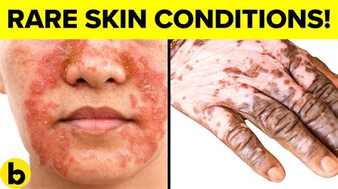 9 Destructive Skin Diseases And Why You Will Get Them Youtube