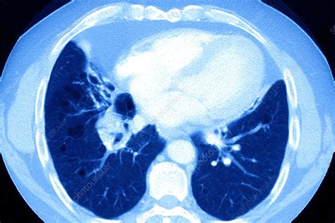 Lung Cancer Ct Scan Stock Image C0297540 Science Photo Library