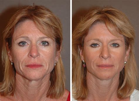 How Long Does It Take To Recover From A Facelift