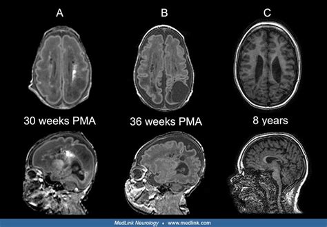 Neonatal White Matter Injury Medlink Neurology