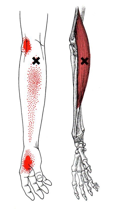 Brachioradialis The Trigger Point And Referred Pain Guide