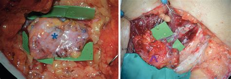 Compartimental Harvesting Of Dual Lymph Node Flap From The Right