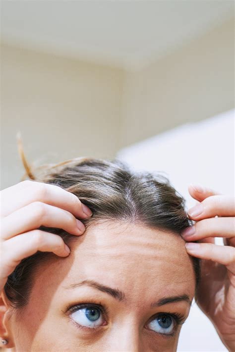 What Causes Scalp Acne How To Treat Pimples On Your Scalp Lupon Gov Ph