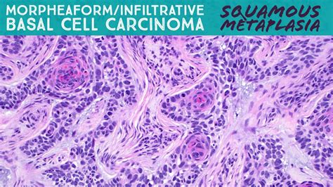Morpheaform Basal Cell Carcinoma Histology