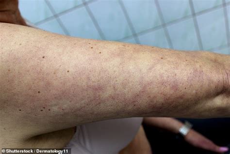 Dermatologists Warn Red Spots Blisters And Itchy Wheals Could Be A